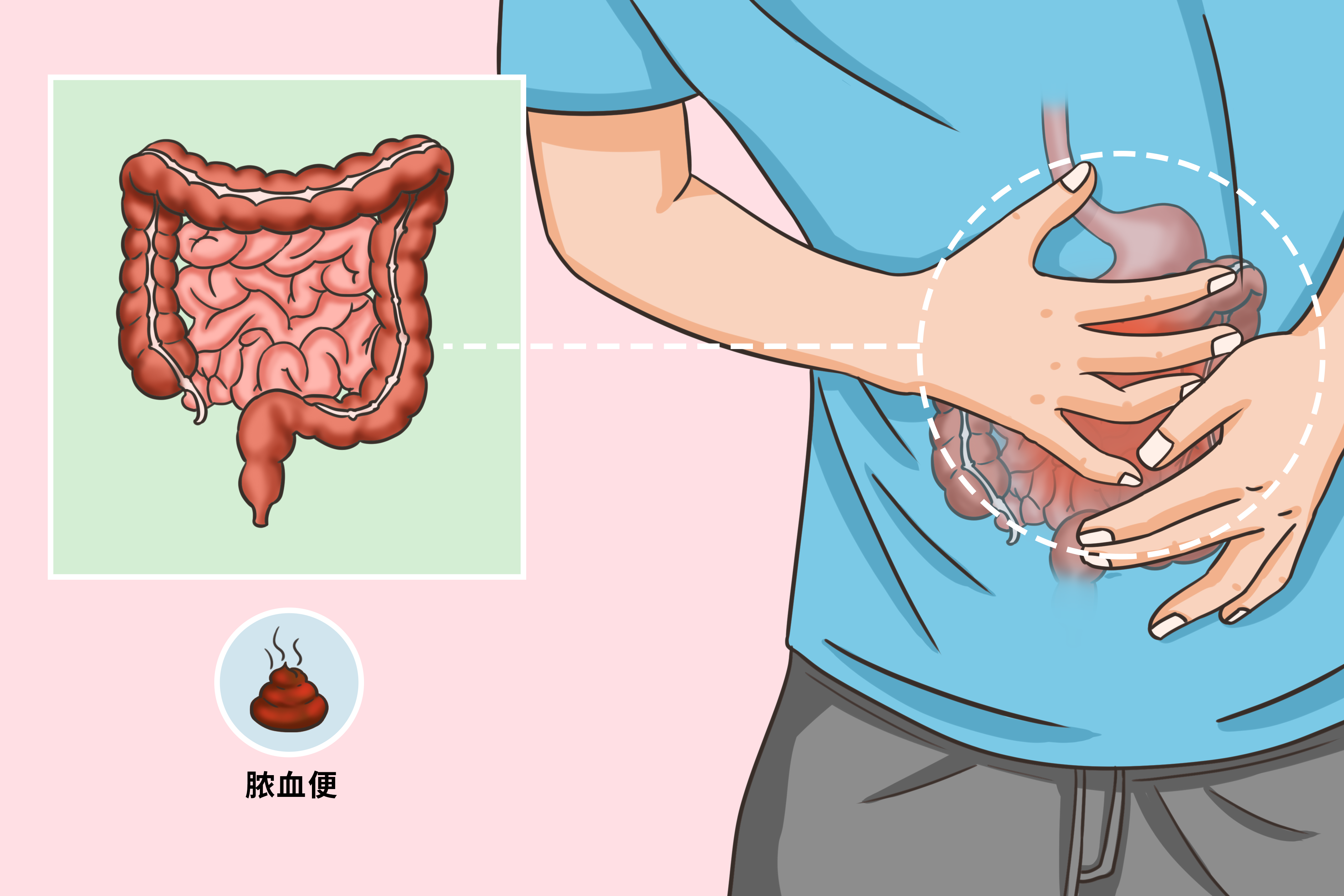 溃疡性结肠炎脓血便图片 一般性结肠炎会有脓血便的图片